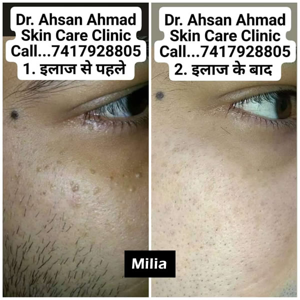 Before After